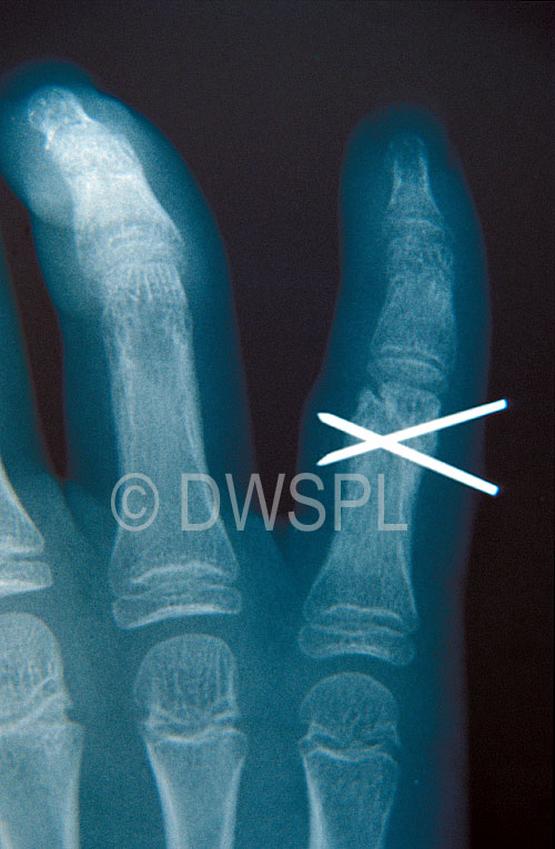XRAY OF CHILD'S HAND SHOWING WHERE THE FIGURE IS BROKEN