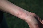 Ailment, ailments, people, woman, women, female, females, mozzie, mozzies, mosquito, mosquitoes, mosquito bite, mosquito bites, bite, bites, itch, itches, itching, arm, arms, Australia, Sport pictures, Sports, balloon images, hot air balloons